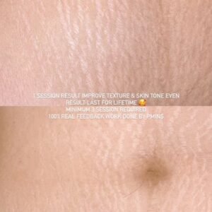 Stretch Mark Revision