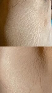 stretch mark camouflage