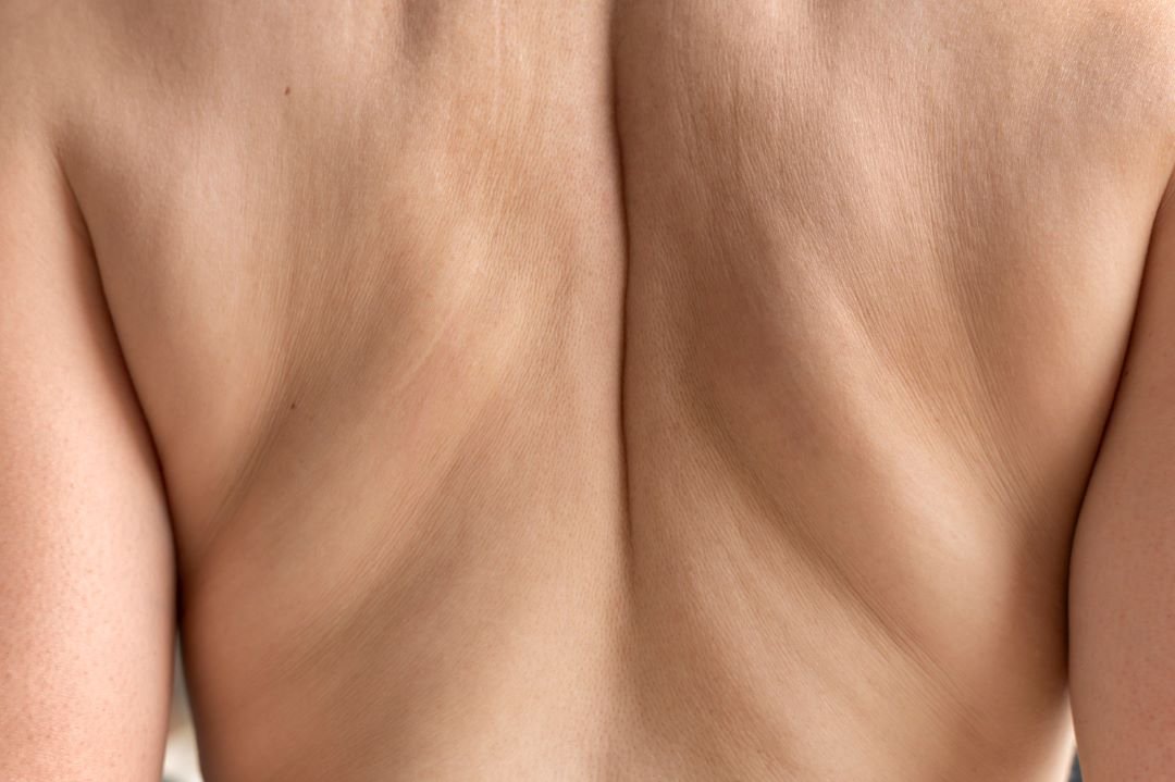 stretch mark tattooing aftercare