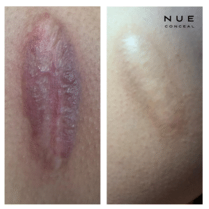 trauma-informed tattooing