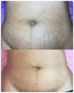 stretch mark tattooing