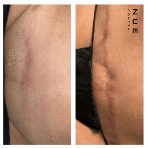 Benefits of Camouflaging Scars