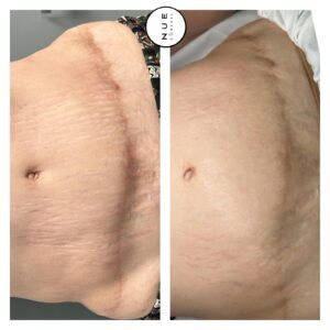 tattooing for post-surgical scars