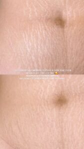 inkless stretch mark