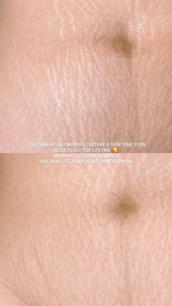 inkless stretch mark