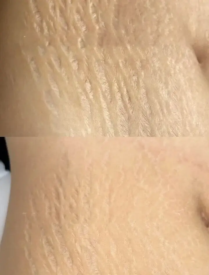 scar camouflage tattooing