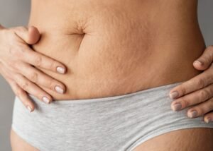 stretch mark camouflage tattooing