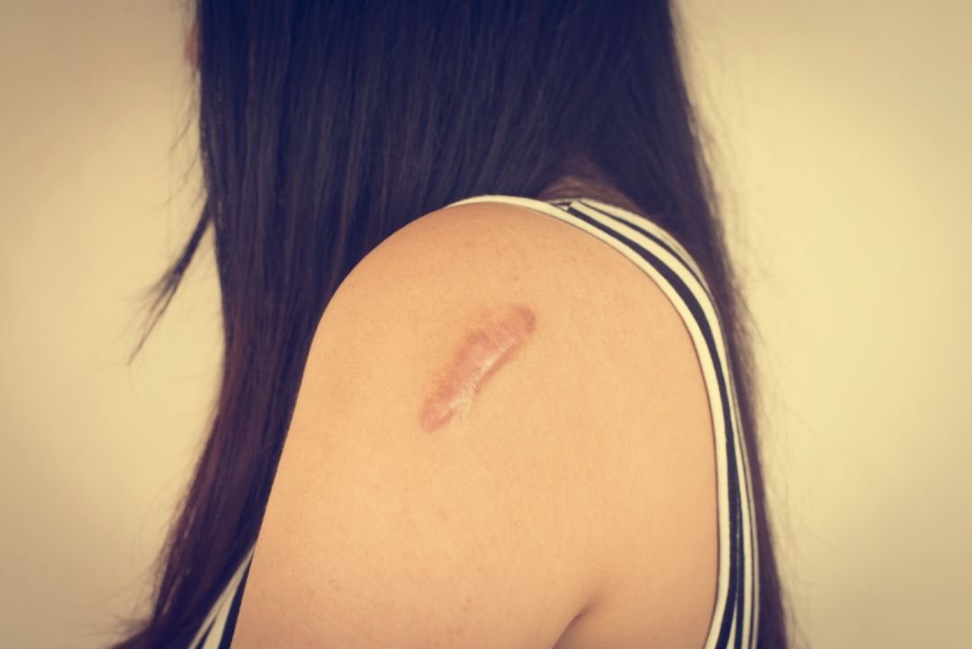 Best Techniques for Blending Scars