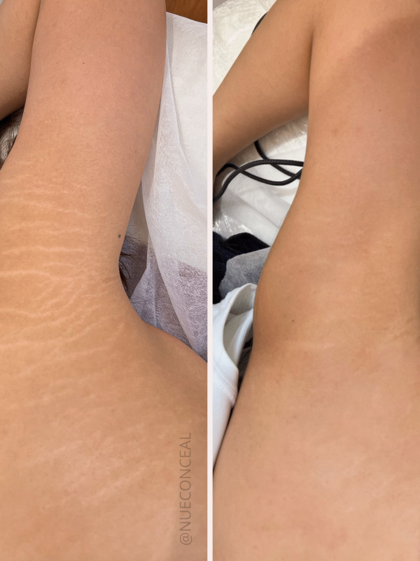 Scar Revision Nue Conceal