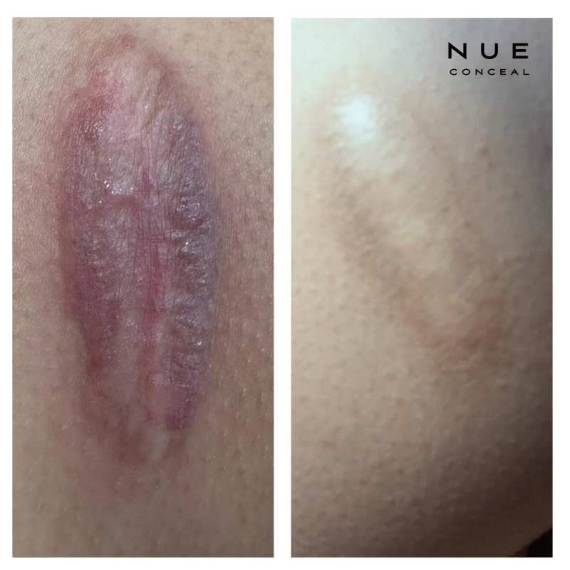 Scar Revision Nue Conceal