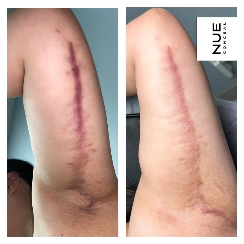 Scar Revision Nue Concel