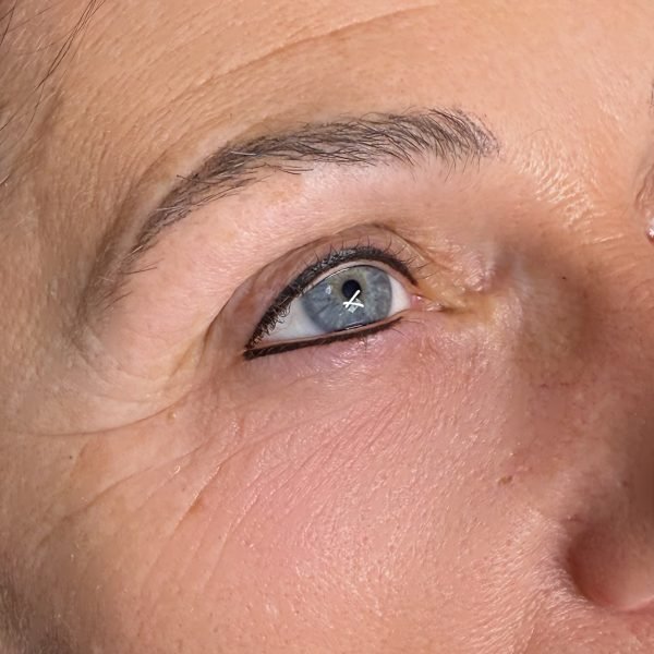 Lash Enhancement