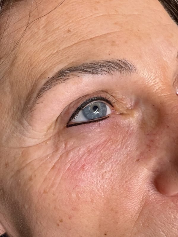 Lash Enhancement