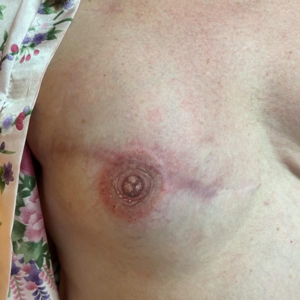 3D Areola Tattoo