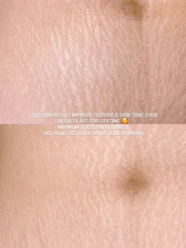 Stretch Mark Revision