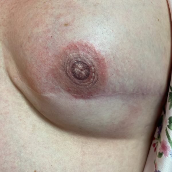 3D Areola Tattoo Coverup