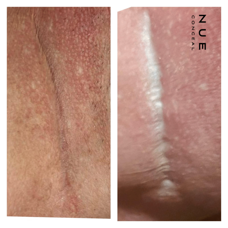 Scar Revision Nue Conceal