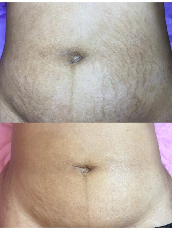 Stretch mark on belly_