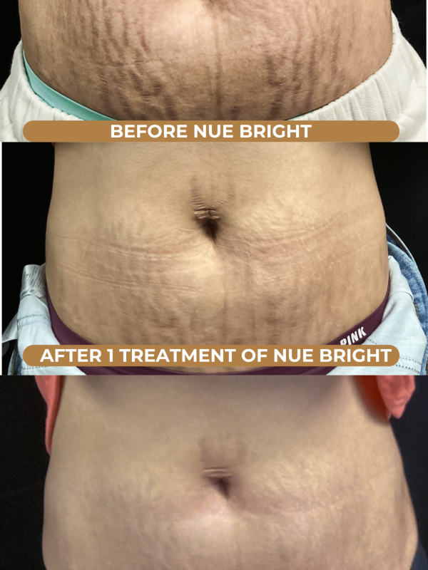 Stretch marks on belly first and second session